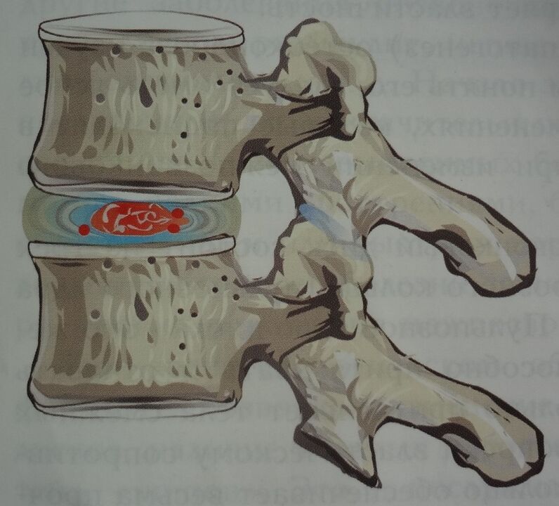 Damage to the pulpy nucleus of the intervertebral disc in the first stage of cervical osteochondrosis