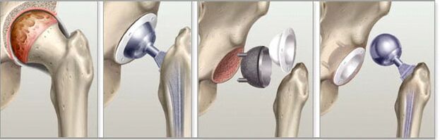 hip prosthesis for osteoarthritis