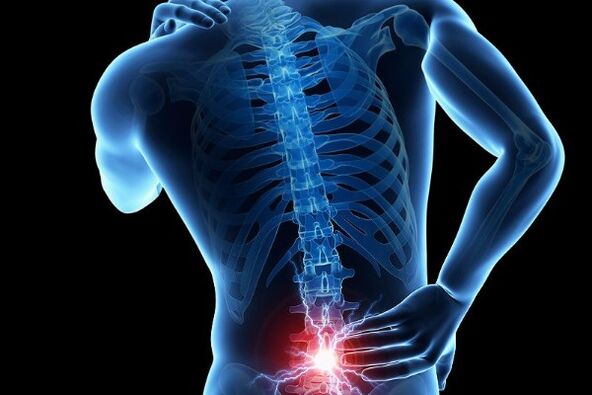Acute low back pain is a symptom of displacement of the intervertebral discs