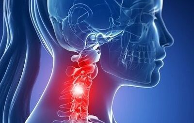 Neck osteochondrosis