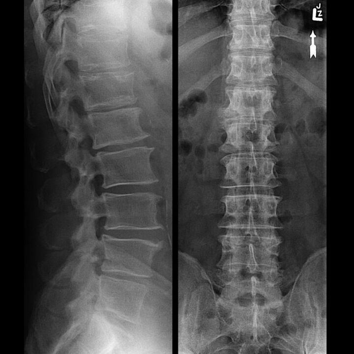 Facing the spine with osteochondrosis
