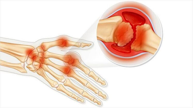 damage to hand joints due to arthritis