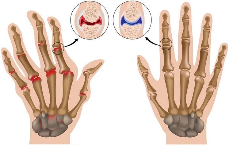 healthy hand joints and joints damaged by osteoarthritis