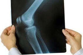 osteoarthritis of the knee joint on x-ray